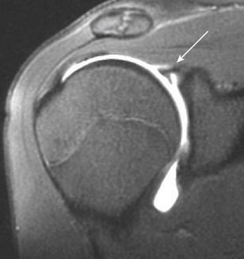 FIG. 50.5, Coronal T1-weighted fat-suppressed MR arthrographic image of the right shoulder in a 27-year-old man 1 year following SLAP repair with recurrent right shoulder pain and instability. SLAP tear (arrow).