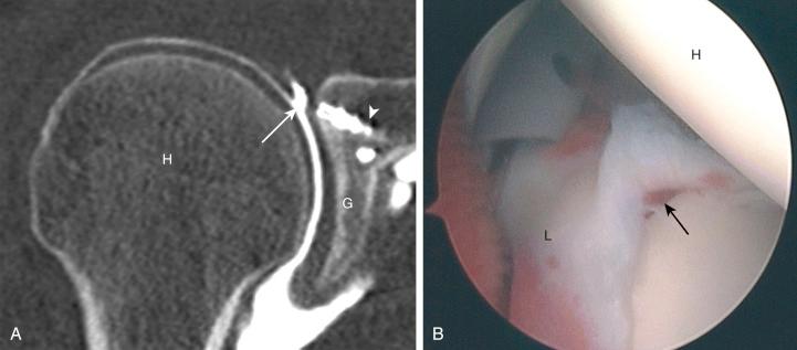 FIG. 50.6, (A) CT arthrography in 28-year-old man with recurrent SLAP tear after repair. CT arthrogram shows lateral extension of contrast medium ( arrow) into the superior labrum. (B) Arthroscopic view from posterior portal confirms presence of type II SLAP tear (arrow). L, labrum, H, humeral head, Arrowhead, metal anchorets, G, glenoid labrum.