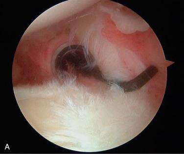 FIG. 50.7A, Arthroscopic image as viewed from the posterior portal of a 32-year-old man who underwent type II SLAP repair 9 months earlier, with evidence of synovitis of the rotator interval, scarring of the long head of the biceps tendon to the capsule, and superior and posterosuperior capsulitis.