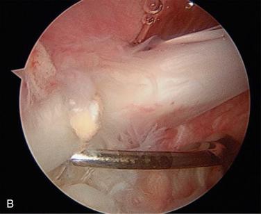 FIG. 50.7B, Arthroscopic image as viewed from the posterior portal of a 34-year-old man with failed type II SLAP repair 13 months earlier. There is evidence of a loose anchor (under probe), scarring of the long head of the biceps to the superior and anterosuperior capsule, synovitis in the rotator interval, and sutures that have loosened.