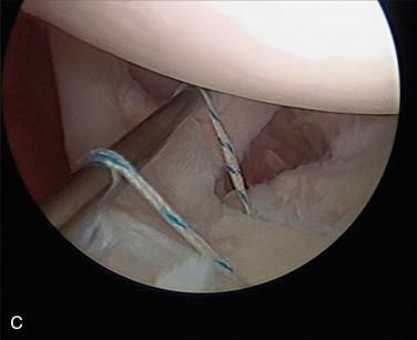 FIG. 50.7C, Arthroscopic image as viewed from the posterior portal of a 35-year-old man who underwent type II SLAP repair 7 months earlier, with evidence of loose sutures and an unstable long head of the biceps attachment.