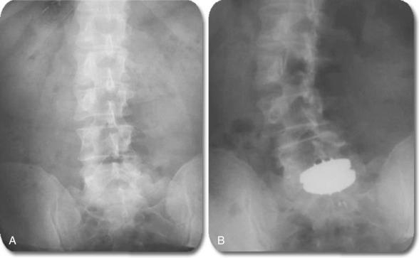 FIG. 104.1, (A) Preoperative radiograph of a patient with a mild coronal deformity. (B) Postoperative radiograph demonstrating significant coronal deformity progression after L5–S1 total disc replacement.