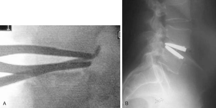 FIG. 104.2, (A) Intraoperative fluoroscopic image demonstrating posterior longitudinal ligament release with a curved curette. (B) Postoperative radiograph demonstrating poor implant positioning secondary to inadequate release of the posterior longitudinal ligament and posterior anulus.