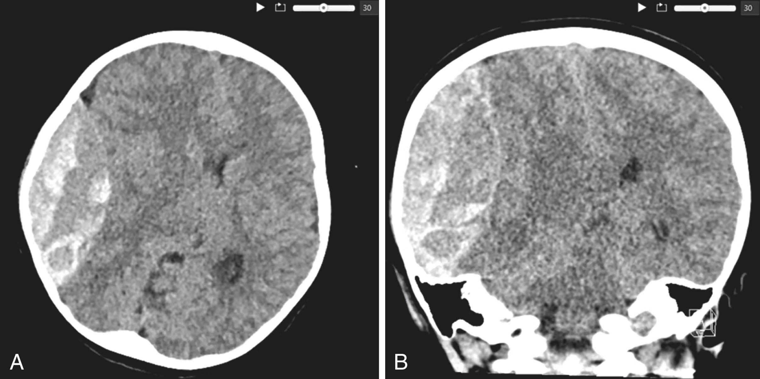 Figure 1.1, Head CT without contrast axial (A) and coronal (B) views demonstrate a large 8.5 cm right parietal epidural hematoma with 1 cm midline shift. Note the ominous “swirl sign” or areas of hypodensity in the hyperdense clot, which is concerning for active extravasation.
