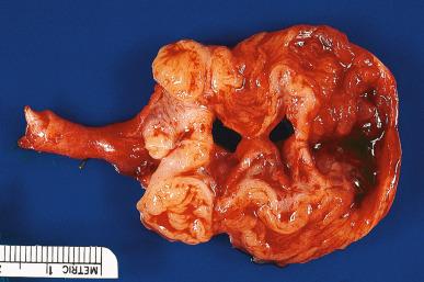 Figure 34.1, Gross appearance of chronic salpingitis with superimposed acute changes.