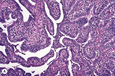 Figure 34.2, Chronic Salpingitis.