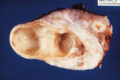 Figure 34.4, Fusion of fallopian tube and ovary into a tubo-ovarian abscess.