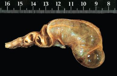 Figure 34.5, Gross appearance of hydrosalpinx showing the typical retort-type appearance.