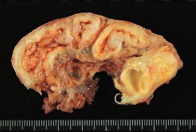 Figure 34.6, Large caseating nodules in tuberculous salpingitis.