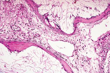 Figure 34.7, Granulomatous reaction to contrast material injected into the fallopian tube.