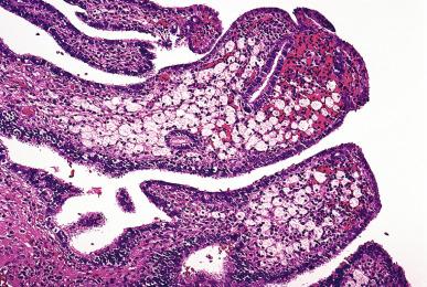 Figure 34.8, Xanthogranulomatous salpingitis.