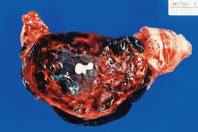 Figure 34.9, Ruptured tubal pregnancy with marked hemorrhage (hematosalpinx). The tiny embryo is identifiable in the center of the clot.