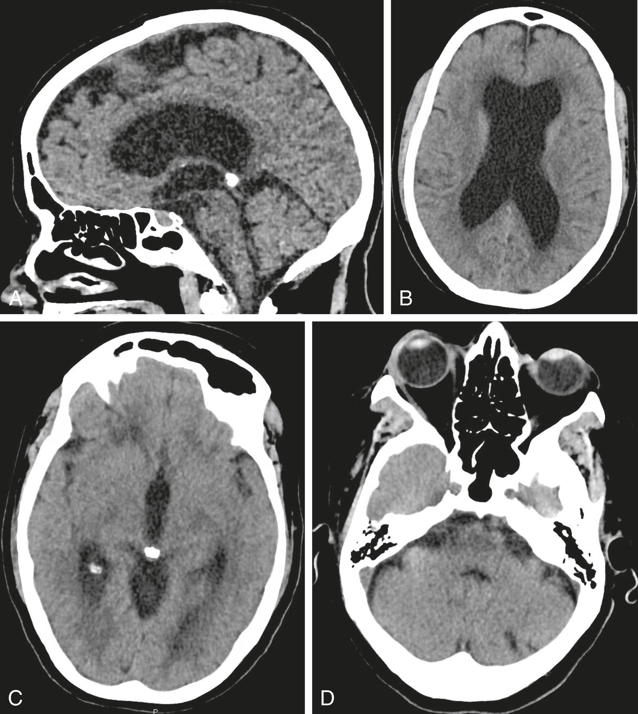 Fig. 63.1, Sagittal (A) and axial (B-D) views of a head CT without contrast demonstrates enlarged lateral (B) and third ventricles (C) with a normal fourth ventricle (D), as well as a hyperdensity near the cerebral aqueduct (C).