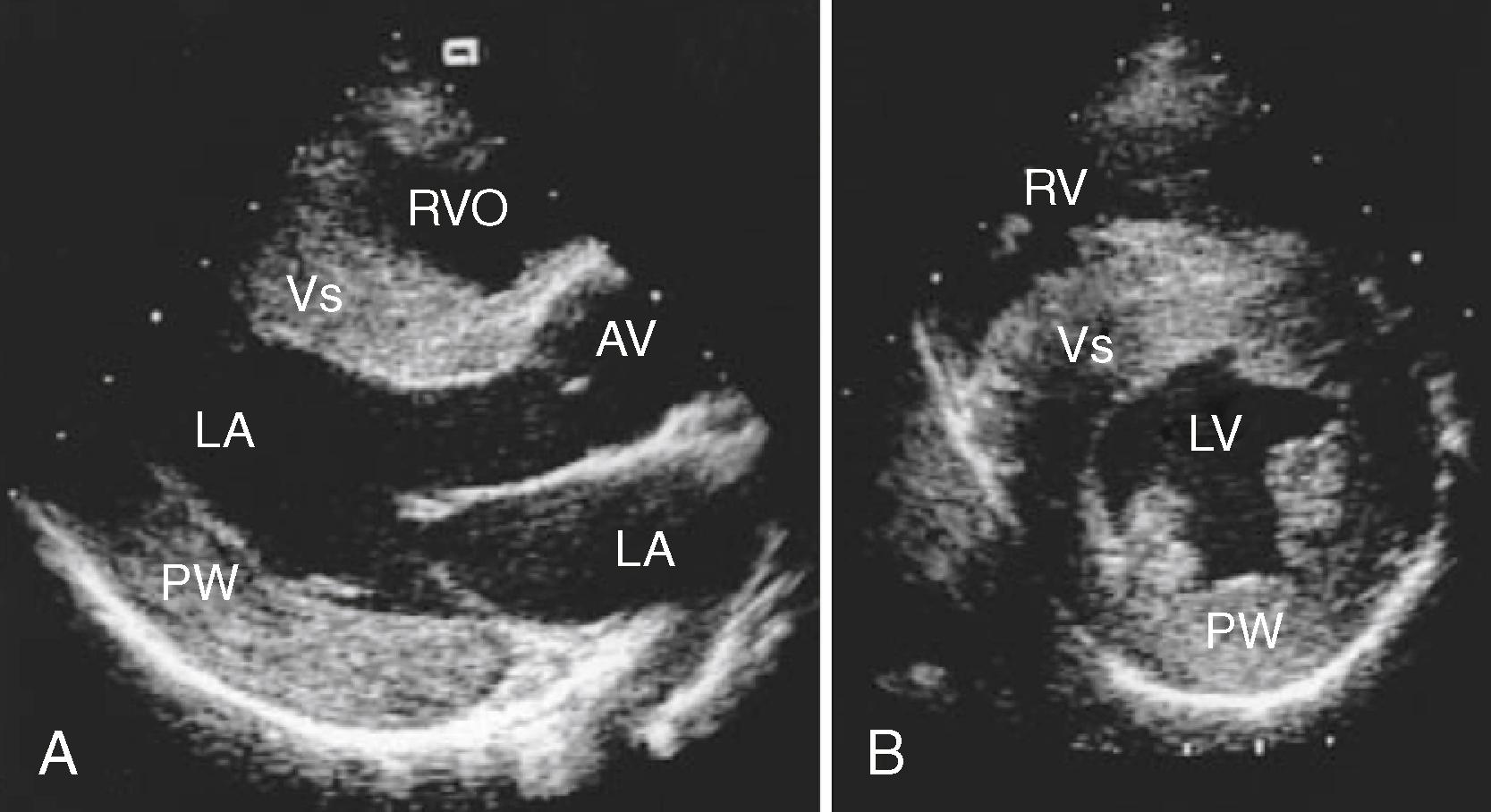 Figure 76.1, A and B, Echocardiograms in a patient with Friedreich ataxia. The myocardium, including the papillary muscles, is diffusely increased in thickness and has a granular texture. AV , Aortic valve; LA , left atrium; LV , left ventricle; PW , posterior wall; RV , right ventricle; RVO , right ventricular outflow; Vs , ventricular septum.