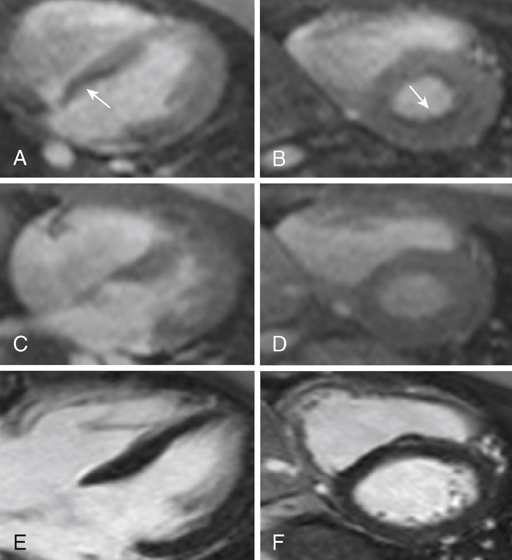 Figure 76.2, Friedreich ataxia stress perfusion cardiac magnetic resonance imaging. Stress perfusion ( A and B ), resting perfusion ( B and C ), and late postgadolinium imaging shows a significant subendocardial perfusion abnormality, which is most prominent along the basal inferoseptum as seen in the horizontal long-axis ( A, C, and E ) and basal short-axis ( B, D, and F ) planes. Corresponding late gadolinium enhancement images show no late gadolinium enhancement in the region of perfusion abnormalities that are consistent with absence of infarct scar or fibrosis.