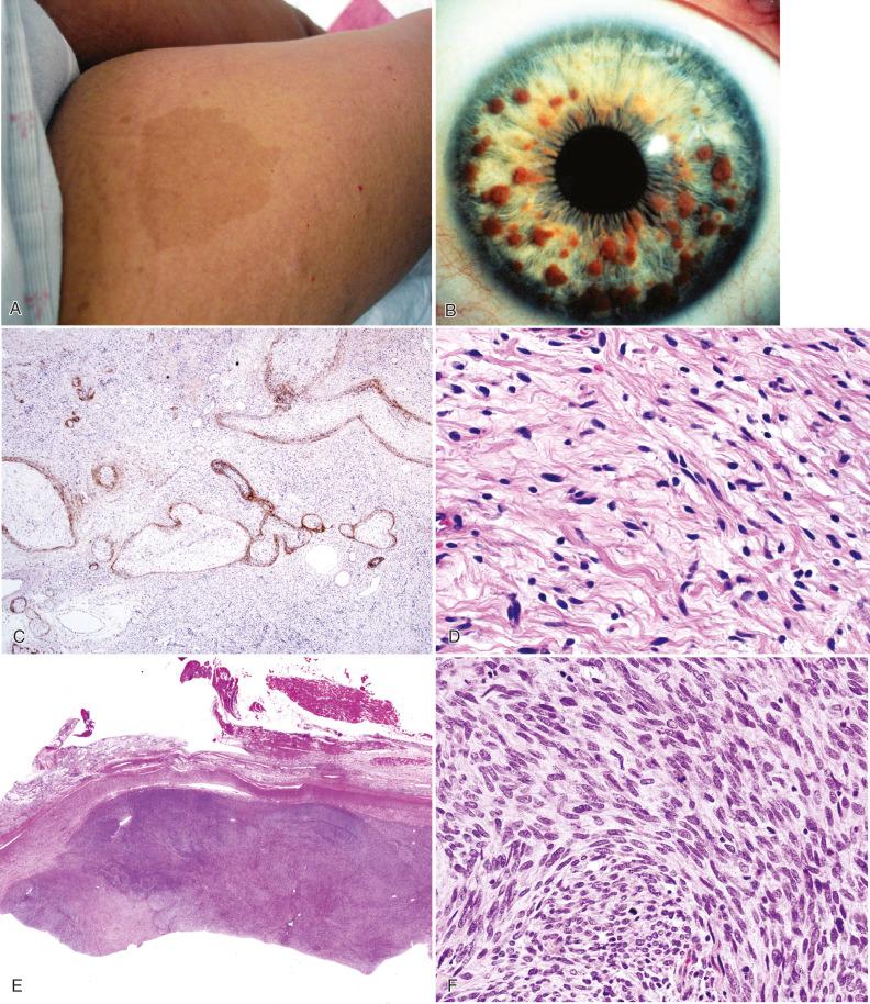 Fig. 22.1, Neurofibromatosis type 1 (NF1). (A) Large café-au-lait macule on the thigh of a patient with NF1. (B) Lisch nodules (pigmented iris hamartomas). (C) Plexiform neurofibroma stained with epithelial membrane antigen (EMA) to highlight the perineurial cells surrounding multiple involved nerve fascicles. (D) The high-magnification features of plexiform neurofibroma show “wavy” Schwann cells in a loose to collagenous fibroblastic stroma. (E–G) Malignant peripheral nerve sheath tumor (MPNST) (E, bottom ) arising from a plexiform neurofibroma (E, top ), with fascicular growth pattern, increased cellularity, nuclear hyperchromasia, and frequent mitoses (F). An S-100 immunostain revealed extensive positivity in the neurofibroma (upper left) and decreased expression in the MPNST ( lower right; G). (H) “Optic glioma” of left optic nerve on T2-weighted magnetic resonance imaging. (I) Optic glioma resembling pilocytic astrocytoma, but invading optic nerve parenchyma between septae. (J) Meningothelial hyperplasia overlying optic glioma (EMA stain).