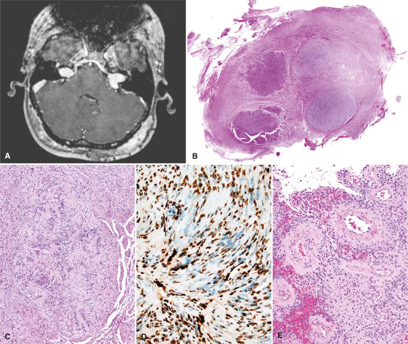 Fig. 22.2, Neurofibromatosis type 2 (NF2). (A) Bilateral vestibular schwannomas detected on contrast-enhanced T1-weighted magnetic resonance imaging. (B, C) Grape-like nodularity in an NF2-associated schwannoma. (D) Mosaic pattern of immunoreactive and immunonegative cells for INI1. This pattern is suggestive of syndromic schwannomas (NF2 and schwannomatosis). (E) High-grade NF2-associated meningioma with papillary features. (F) Incidental focus of meningioangiomatosis in an NF2 patient. (G) Glial microhamartoma of NF2 with clusters of dysplastic mononucleated and multinucleated astrocytes.