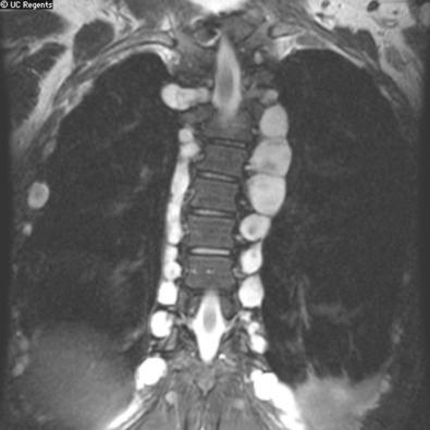 Fig. 22.3, Schwannomatosis. Multiple paraspinal schwannomas seen on coronal T2-weighted magnetic resonance imaging. (Photo generously donated by Dr. Soonmee Cha of the Neuroradiology Division at the University of California, San Francisco.)