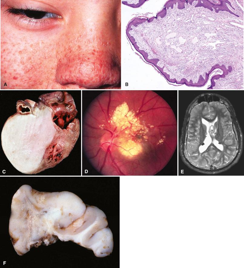 Fig. 22.4, Tuberous sclerosis complex (TSC). (A, B) Facial angiofibromas (“adenoma sebaceum”). (C) Cardiac rhabdomyoma. (D) Retinal astroglial hamartoma with granular calcifications detected on fundoscopic exam. (E) T2-weighted magnetic resonance imaging showing a left ventricular subependymal giant cell astrocytoma (SEGA), multiple subependymal nodules projecting into the ventricles, and a right parietal tuber. (F) Large tuber excised for seizure control. Note the blurred gray-white junction, subcortical involvement, and chalky yellow-white calcifications. (G) Cortical tuber showing numerous dysplastic “balloon cells,” neuronomegaly, and calcifications. (H, I) Fetus with severe TSC showing subependymal nodule (H) and numerous migrating cells with dysplastic features, including glassy eosinophilic cytoplasm (I). (J) SEGA with large gemistocyte-like cells containing neuronal-like nuclei and astrocyte-like cytoplasm. Mast cells are also present. (K) CD34-positive cell with ramified processes in a tuber. (L) Numerous c-kit-reactive mast cells in a SEGA.