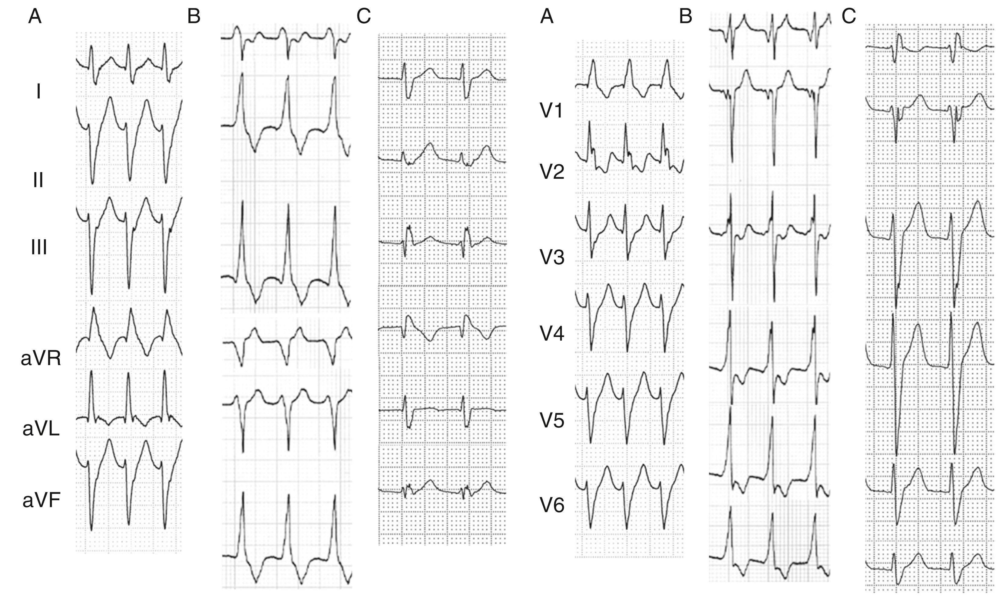 Fig. 83.1, Twelve-lead electrocardiographs of verapamil-sensitive fascicular ventricular tachycardia (VT).