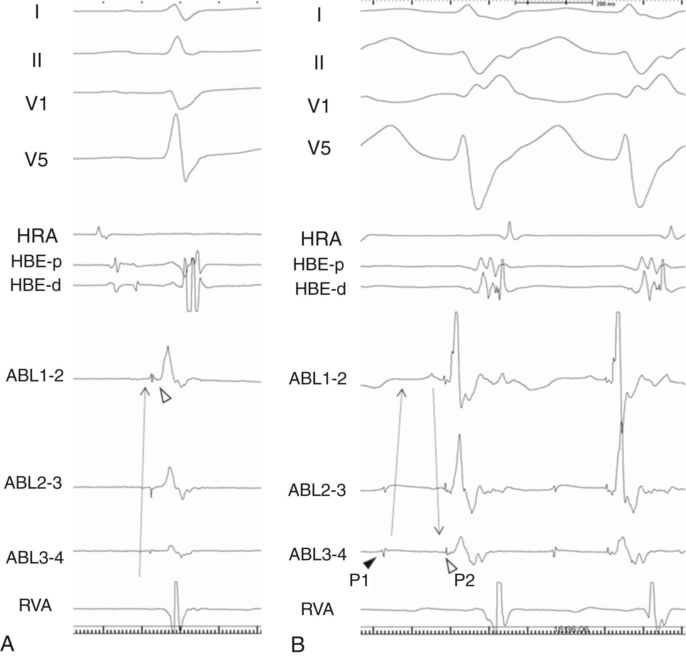 Fig. 83.2, Intracardiac recordings in a patient with left posterior fascicular ventricular tachycardia (VT).