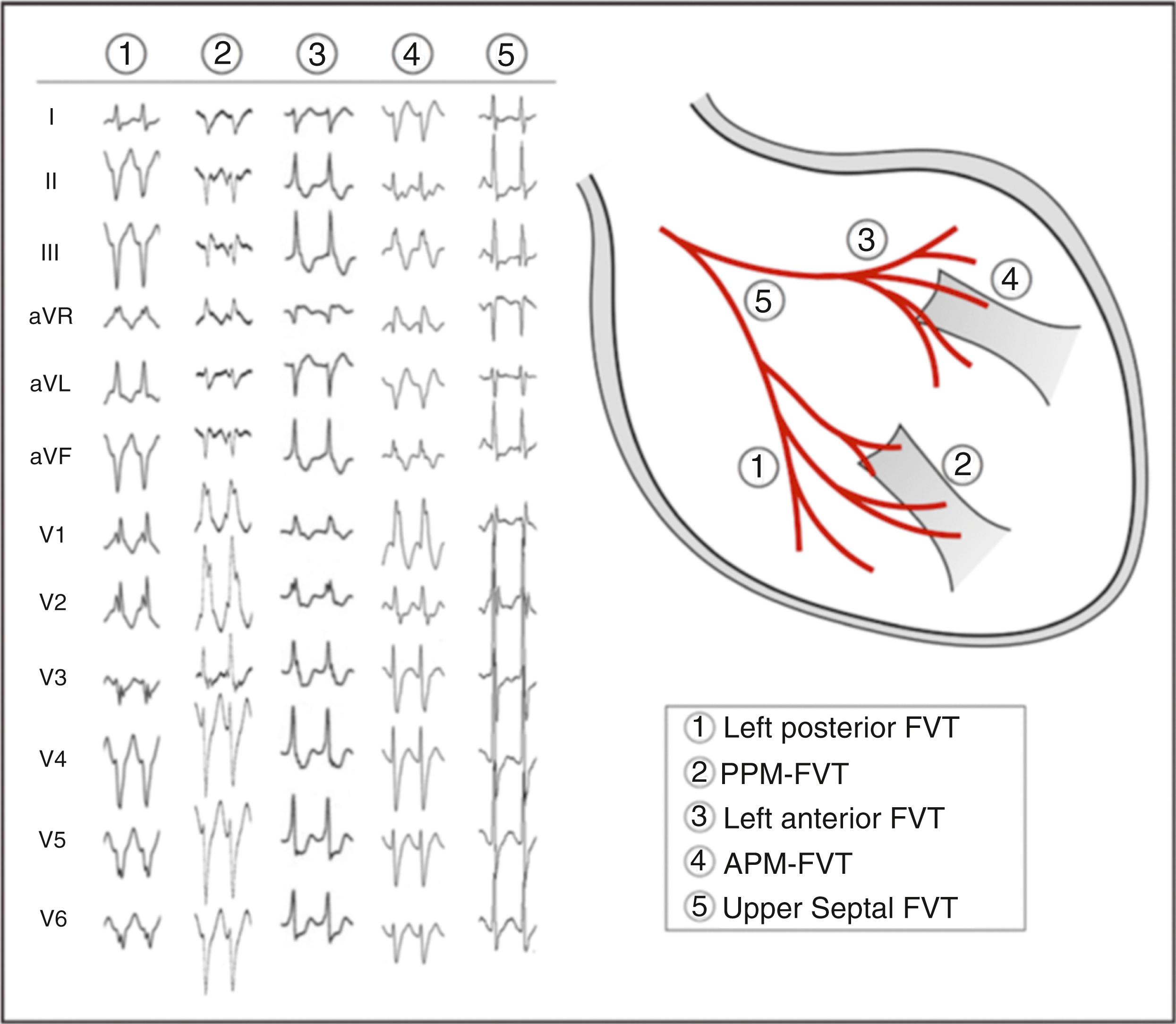 Fig. 83.4, Twelve-lead electrocardiograph and successful ablation sites of five types of verapamil-sensitive fascicular ventricular tachycardia (FVT).