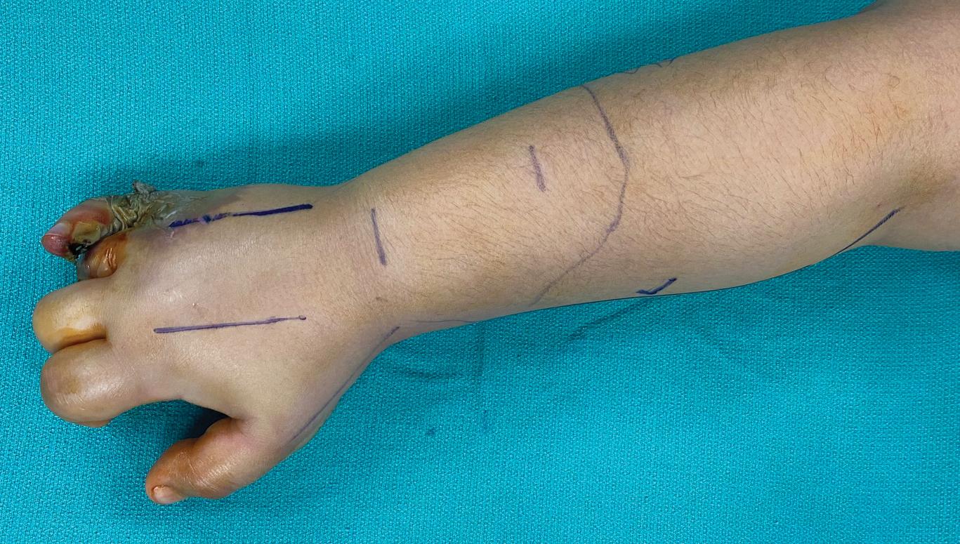 FIGURE 2.11, Two longitudinal incisions parallel and radial to the index finger and ring finger metacarpals on the dorsal side.