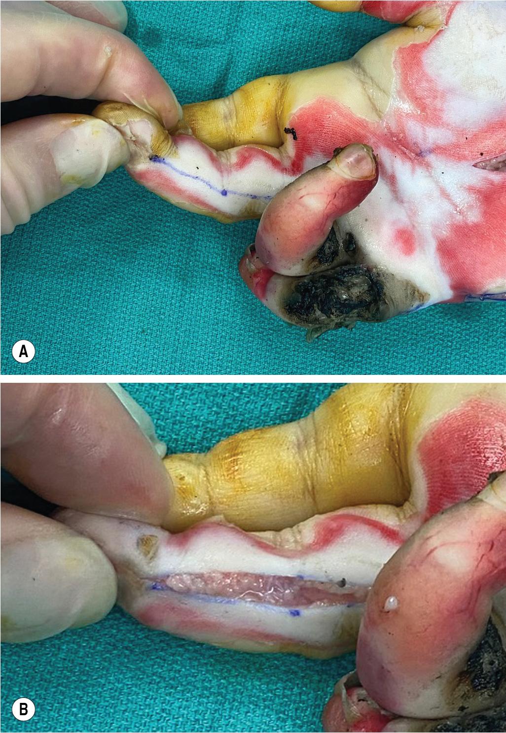 FIGURE 2.14, Incision design and finger release.