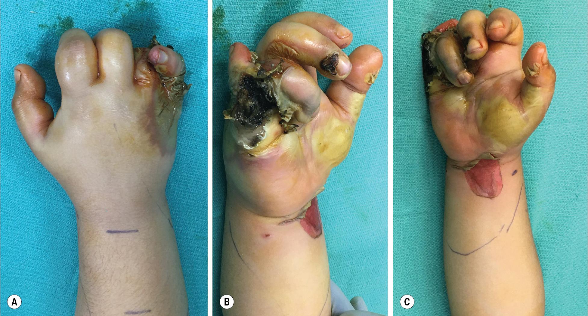 FIGURE 2.1, The thumb and index fingers are viable. There is a near circumferential eschar over the middle finger, which is alive. The ring finger and little finger are necrotic. There is compartment syndrome over the hand, forearm, and upper arm.