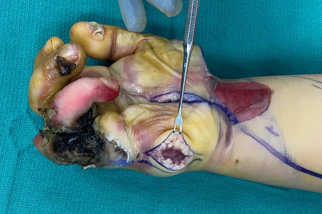 FIGURE 2.10, Hypothenar decompression.