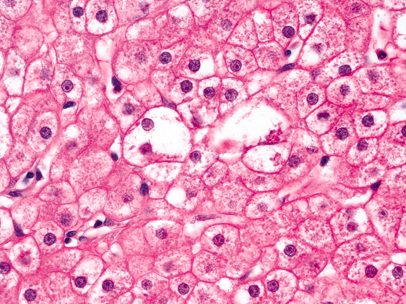 FIGURE 50.1, Ballooned hepatocytes are easily distinguished when surrounded by normal hepatocytes.