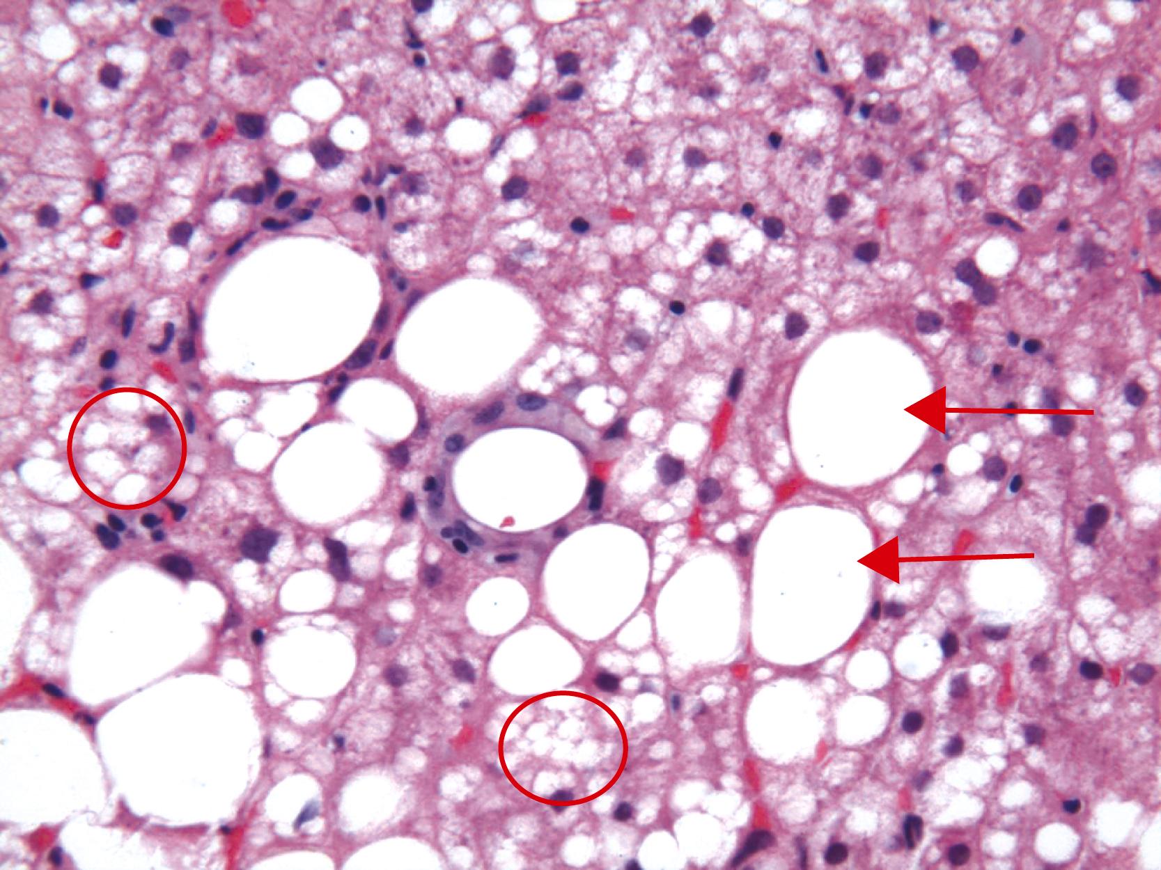 FIGURE 50.3, Mixed large ( arrows )- and small (circles)-droplet macrovesicular steatosis. Each of the two lipogranulomas (center) consists of a single droplet of fat surrounded by pigmented Kupffer cells.