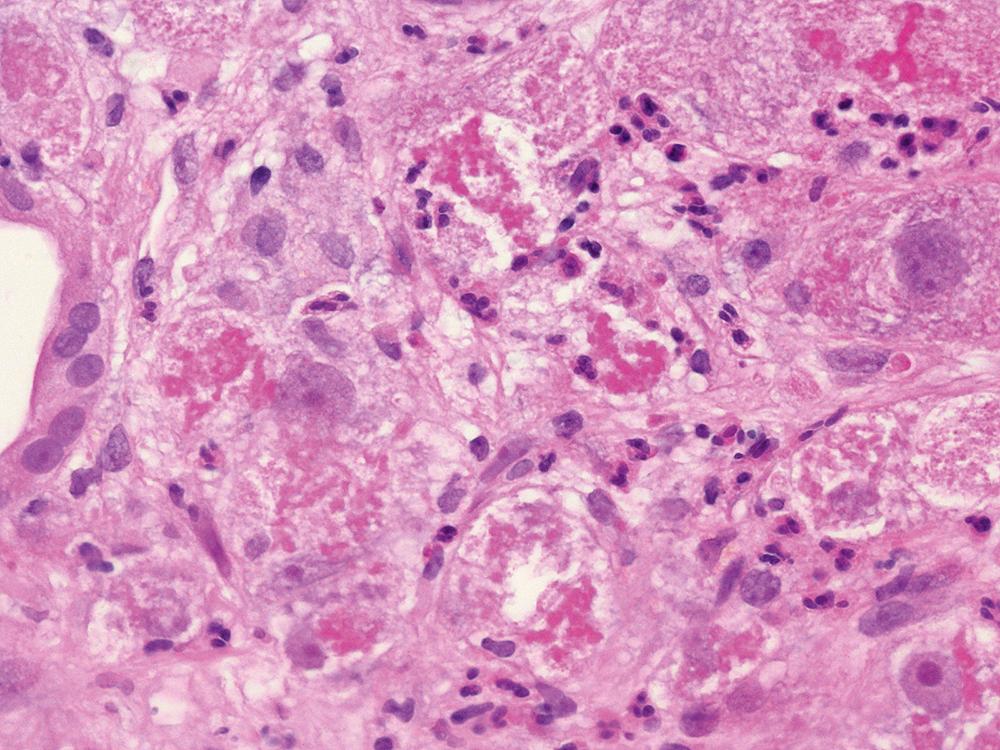 FIGURE 50.4, Multiple areas of satellitosis are evident in this field. Neutrophils surround hepatocytes harboring hyaline material.