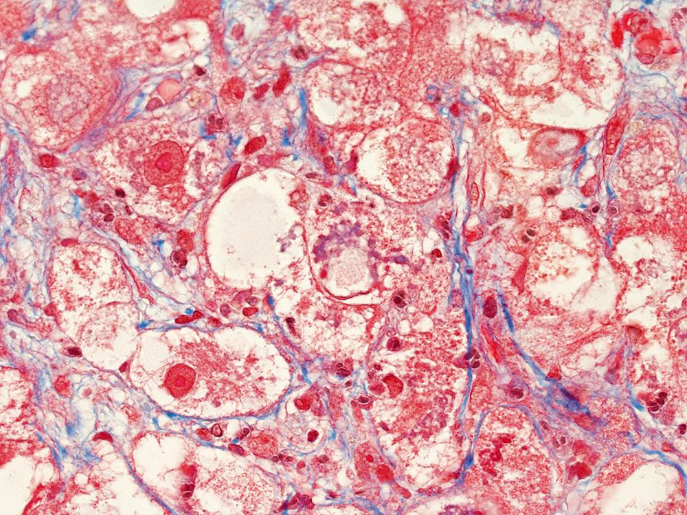 FIGURE 50.6, A large, ropy Mallory-Denk body is seen in the center of the field (trichrome stain).