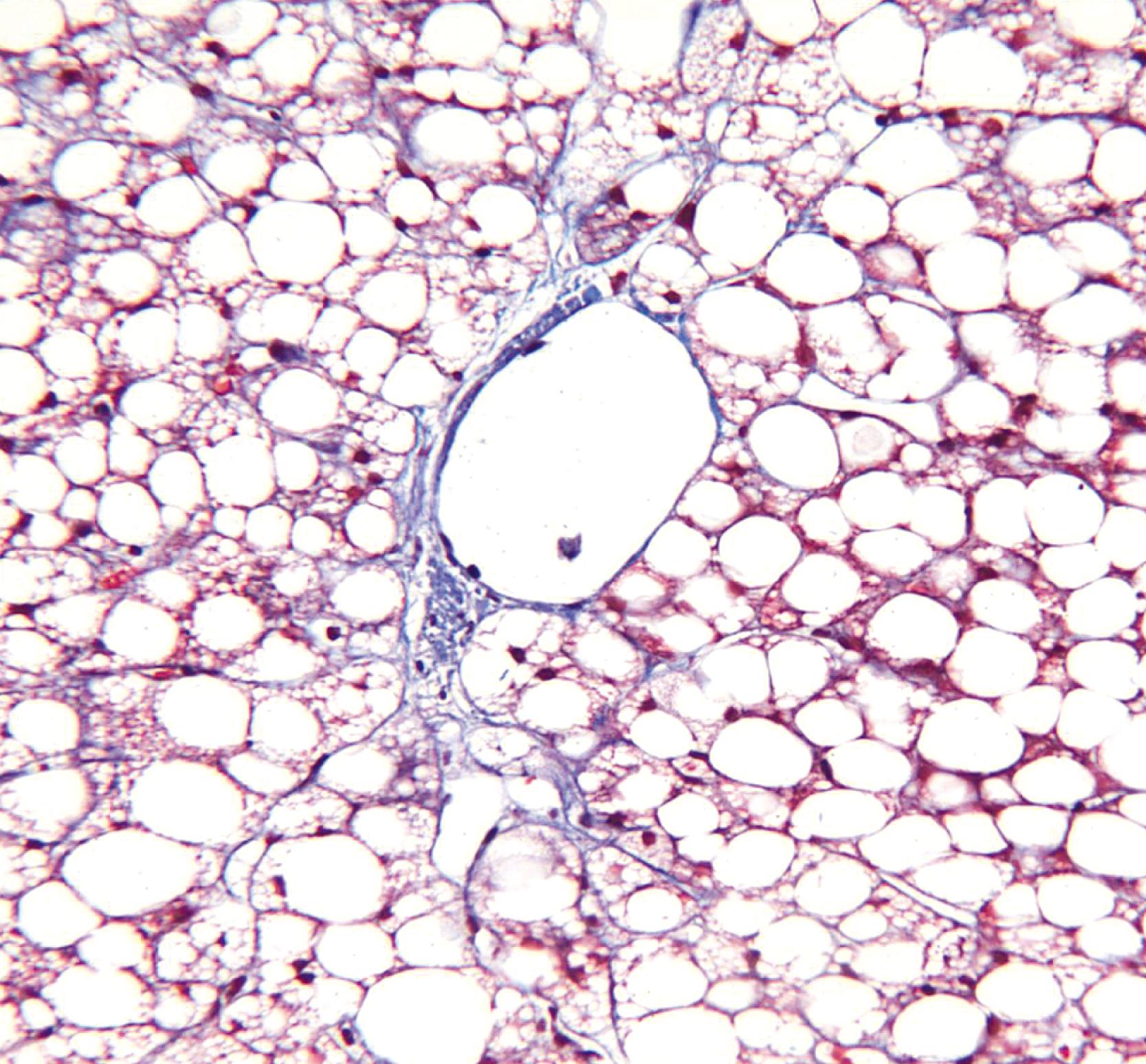 FIGURE 50.7, This biopsy was obtained from a patient with known alcoholism, hepatomegaly, and elevated aspartate aminotransferase and bilirubin values. It contains no inflammation, ballooning, or Mallory-Denk bodies and only a minor degree of fibrosis. Diffuse steatosis is evident, and a significant portion is microvesicular (trichrome stain).