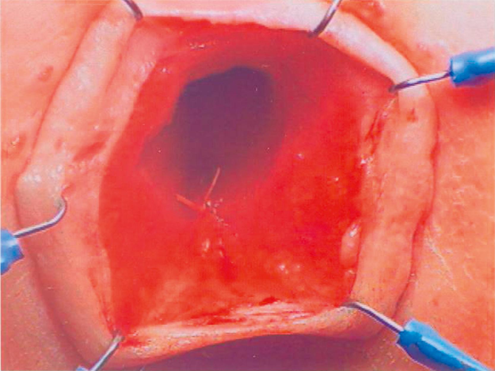 Fig. 36.1, Loss of the anal canal (with no visible dentate line) is seen after a Soave pull-through operation. In this patient, the anal dissection was begun too distally.