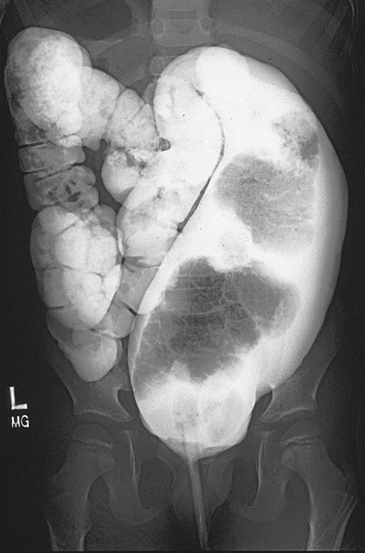 Fig. 36.2, This contrast enema shows a megarectosigmoid colon.