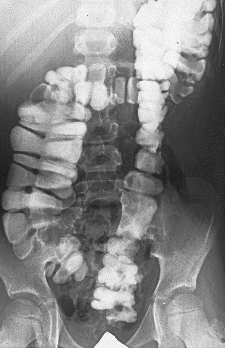 Fig. 36.3, This contrast enema was performed in a patient who had resection of the rectosigmoid colon. Often these patients act like they do not have a rectal reservoir.