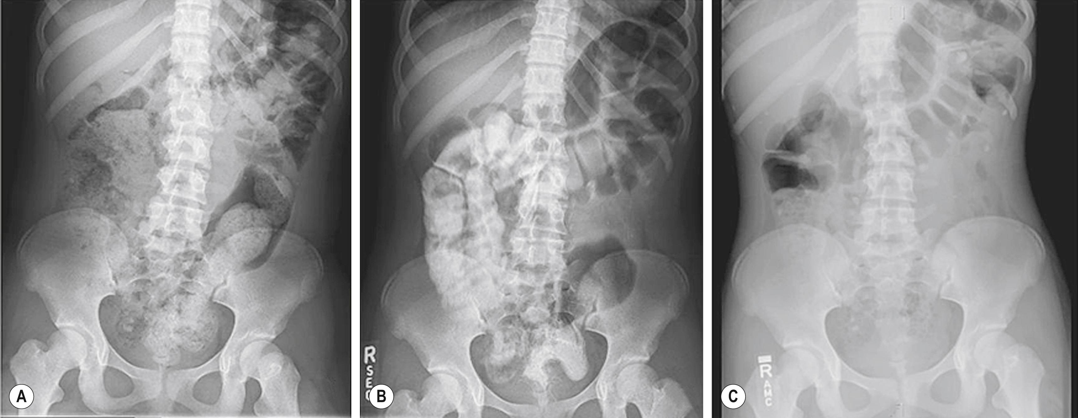 Fig. 36.4, (A, B) This series of abdominal radiographs was obtained during inpatient bowel management and shows progression toward a completely clean colon with daily adjustment of the enema. (C) After 5 days, a postcontrast abdominal film shows minimal evidence of retained fecal material.