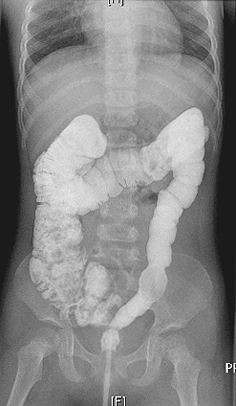 Fig. 36.5, This contrast study shows a nondilated colon.