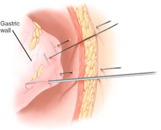 F igure 20-1-4, Four T-fasteners elevating the anterior abdominal wall of the stomach.