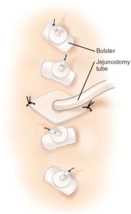 F igure 20-1-10, External view of the completed jejunostomy tube with the four in-line cotton bolsters of the T-fasteners in place.
