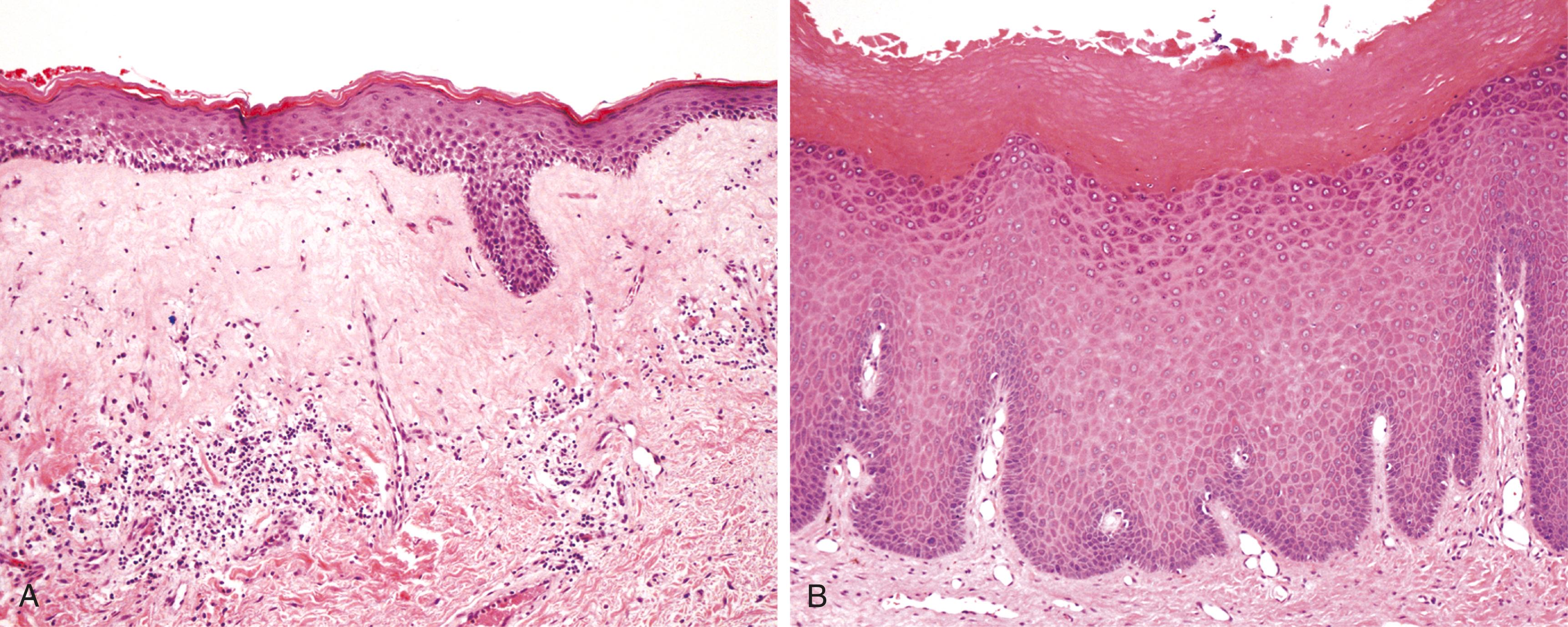 FIG. 17.1, Nonneoplastic vulvar epithelial disorders. (A) Lichen sclerosus. There is marked thinning of the epidermis, fibrosis of the superficial dermis, and chronic inflammatory cells in the deeper dermis. (B) Squamous cell hyperplasia displaying thickened epidermis and hyperkeratosis.
