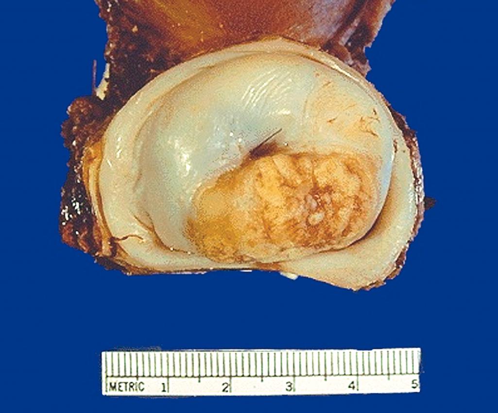 FIG. 17.8, Cervical os with invasive, exophytic cervical carcinoma.