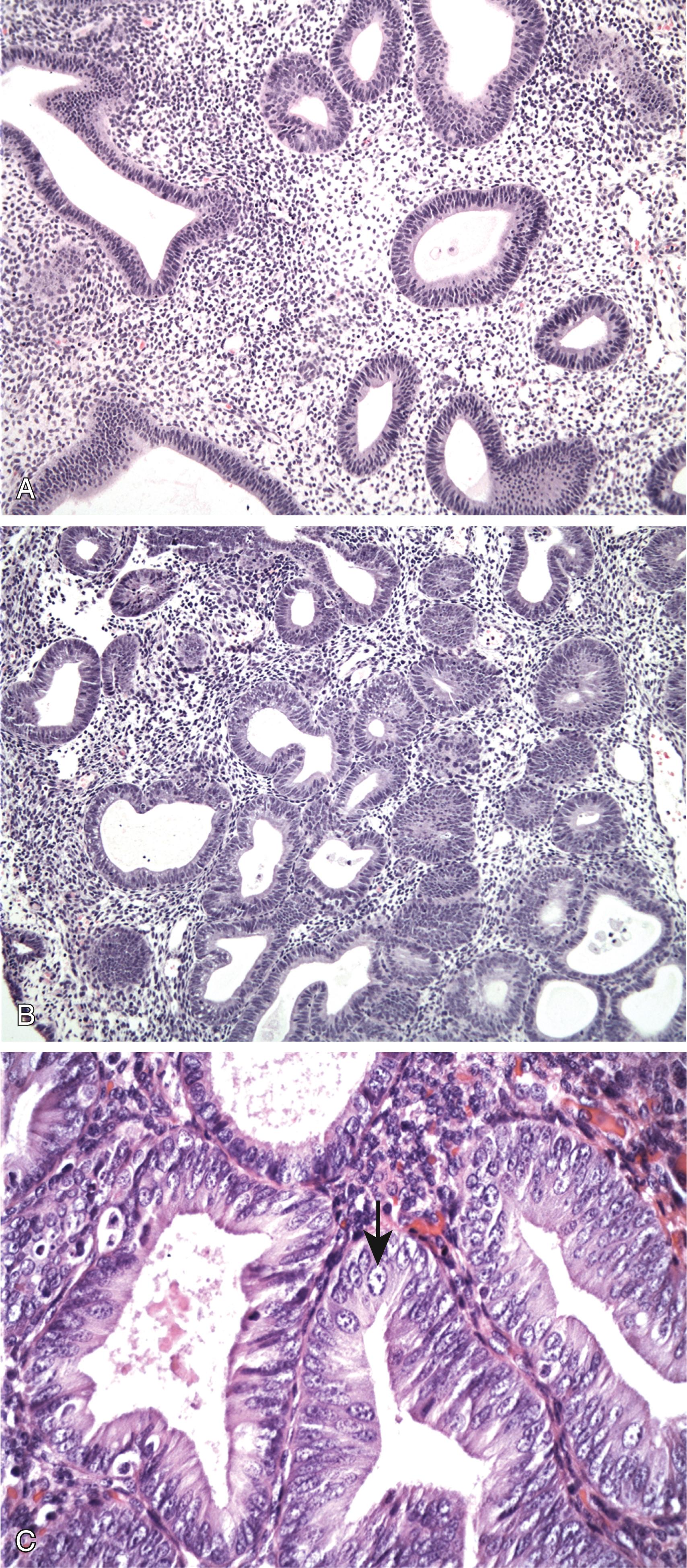 FIG. 17.11, Endometrial hyperplasia. (A) Hyperplasia without atypia, showing architectural abnormalities including mild glandular crowding and cystic gland dilation. (B) Hyperplasia with atypia, seen as glandular crowding and cellular atypia. (C) High magnification of atypical hyperplasia showing rounded, vesicular nuclei with prominent nucleoli (arrow) .