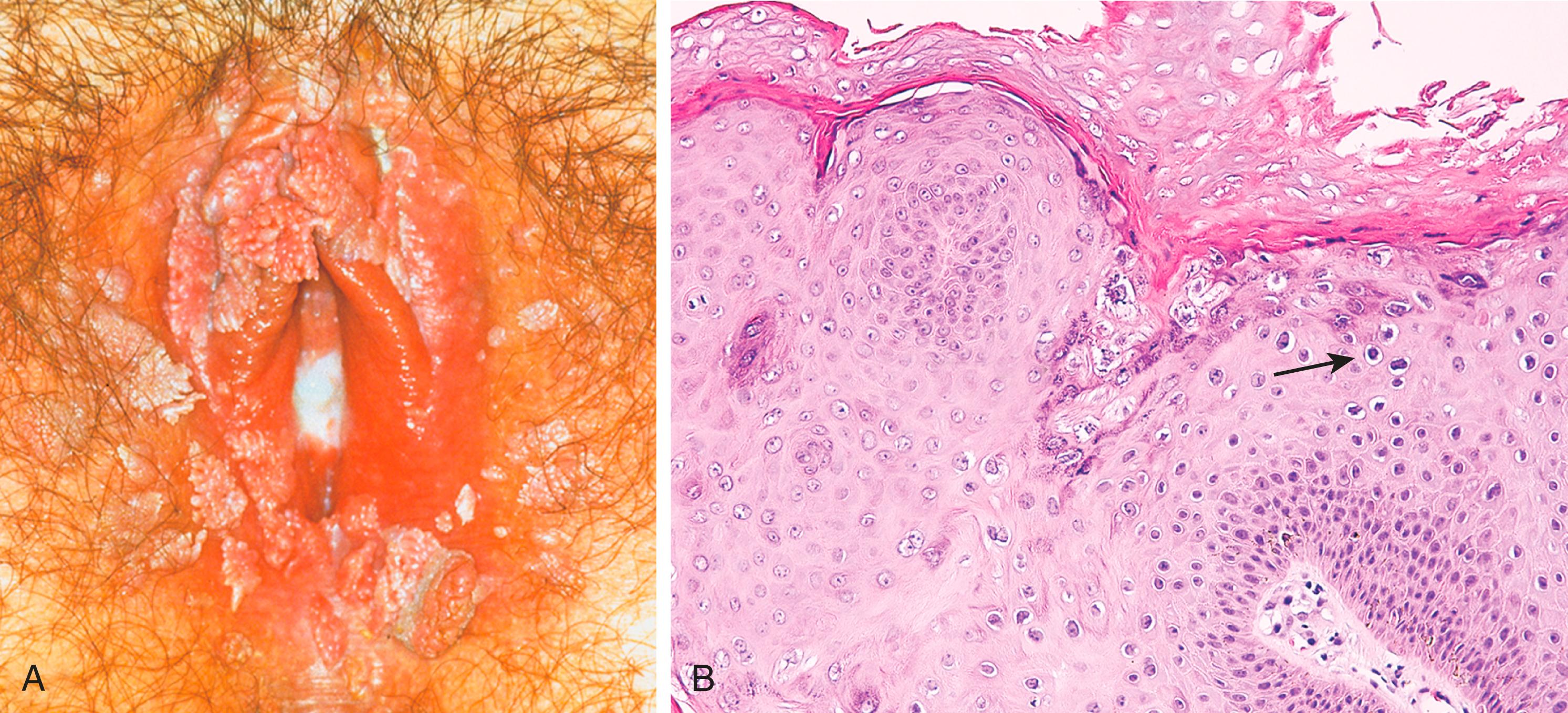 FIG. 17.2, (A) Numerous condylomas of the vulva. (B) Histopathologic features of condyloma acuminatum include acanthosis, hyperkeratosis, and human papillomavirus cytopathic effect (koilocytic atypia) characterized by atypical, enlarged, hyperchromatic nuclei with perinuclear halos (arrow).