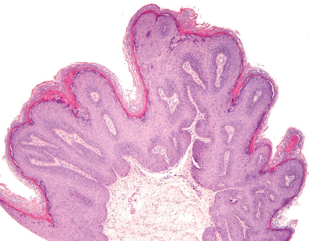 eFIG. 17.1, Condyloma acuminatum. Low-power view showing exophytic, papillary architecture.