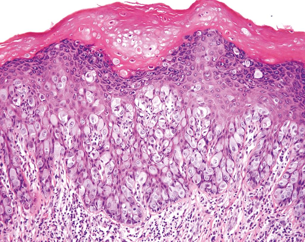 FIG. 17.3, Paget disease of the vulva. Large tumor cells with pale-pink cytoplasm are seen infiltrating the epidermis. Chronic inflammatory cells are present in the underlying dermis.