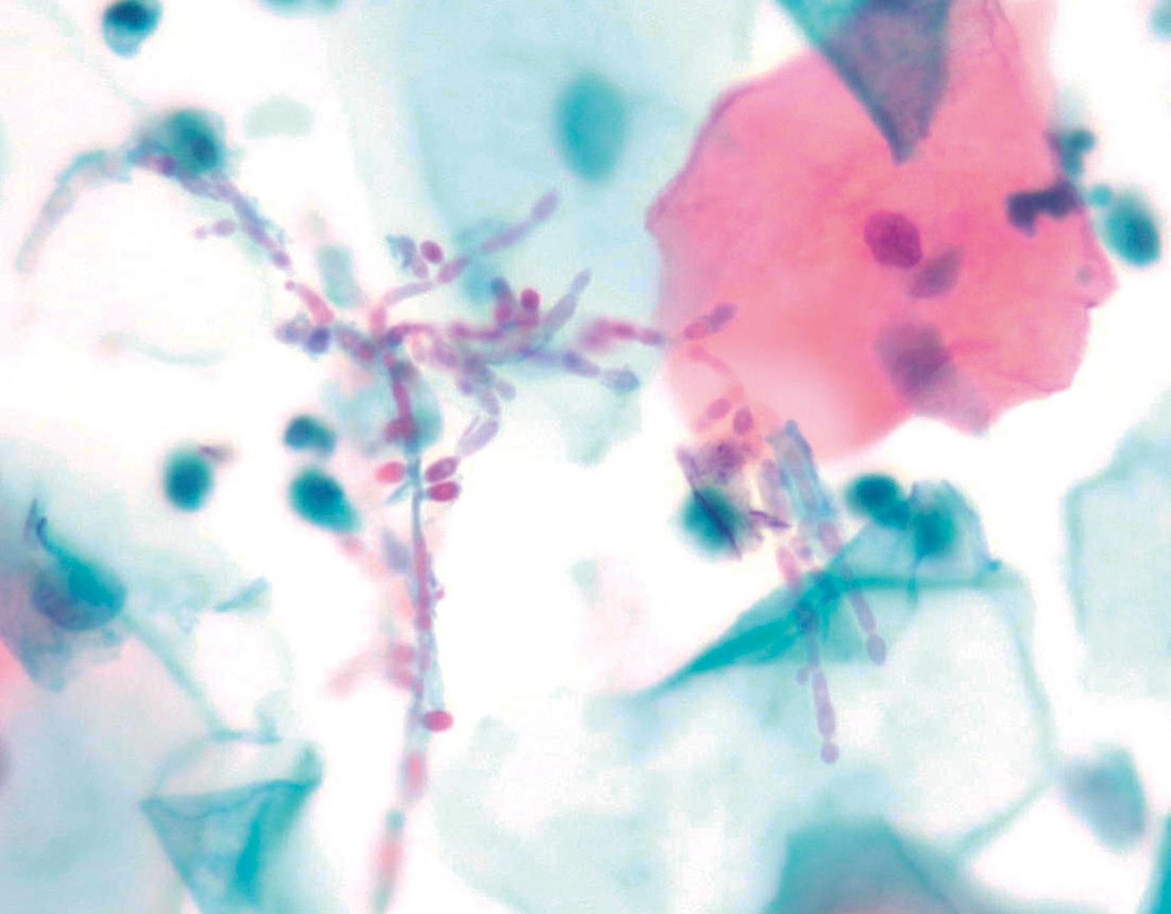 eFIG. 17.2, Candida infection. Hyphal forms are seen in a Papanicolaou test.