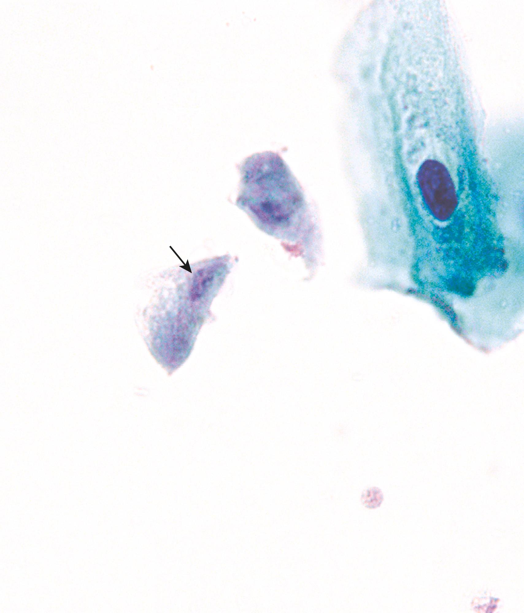 eFIG. 17.3, Trichomonas vaginalis infection. Pap test showing two organisms of T. vaginalis exhibiting a characteristic oval nucleus (arrow) and faint red granules.